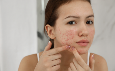 Sve što trebaš znati o aknama!