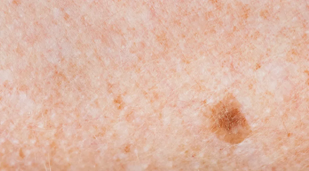 Crvene zastavice i ABCD pravilo u procjeni kožnih promjena