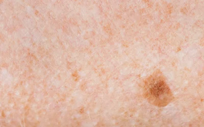 Crvene zastavice i ABCD pravilo u procjeni kožnih promjena