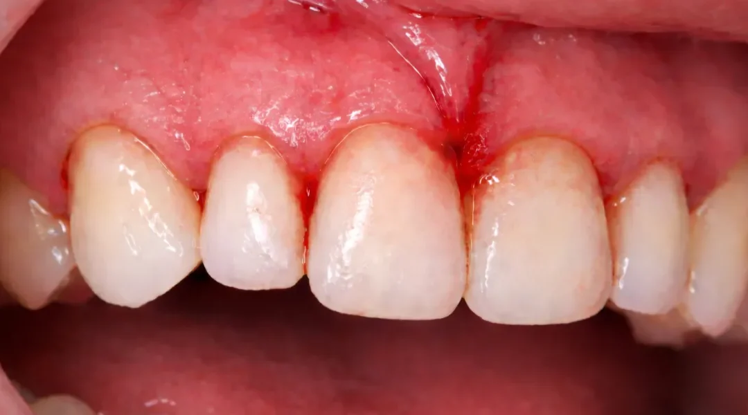 Krvarenje desni koje se vraća: protokol od gingivitisa do parodontitisa (što se mjeri na pregledu i kako se planira kontrola)