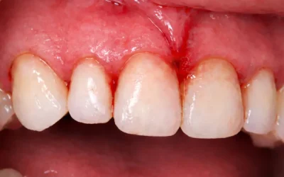 Krvarenje desni koje se vraća: protokol od gingivitisa do parodontitisa (što se mjeri na pregledu i kako se planira kontrola)