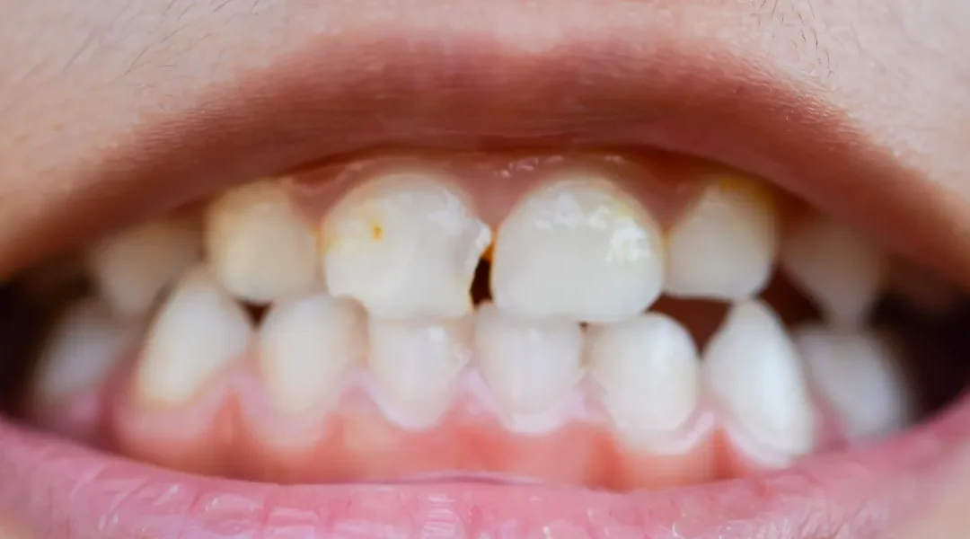 Puknuće ispuna i “bol na zagriz”: diferencijalna dijagnostika (pukotina zuba, sekundarni karijes, visoki kontakt) i kada je hitno