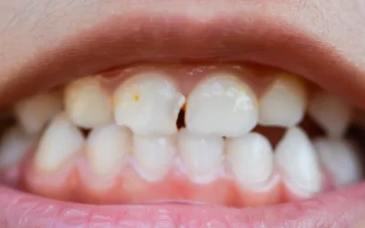 Puknuće ispuna i “bol na zagriz”: diferencijalna dijagnostika (pukotina zuba, sekundarni karijes, visoki kontakt) i kada je hitno