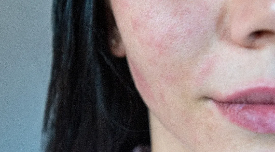 Mapa iritativnih dermatoza lica: kako razlikovati perioralni dermatitis, rozaceju i iritativni kontaktni dermatitis po kliničkim uzorcima