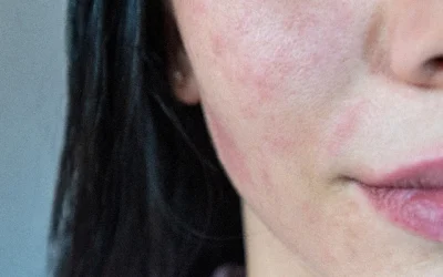 Mapa iritativnih dermatoza lica: kako razlikovati perioralni dermatitis, rozaceju i iritativni kontaktni dermatitis po kliničkim uzorcima